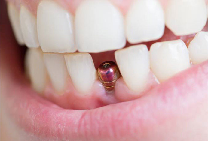 Імплантація зубів: як створити ідеальну посмішку